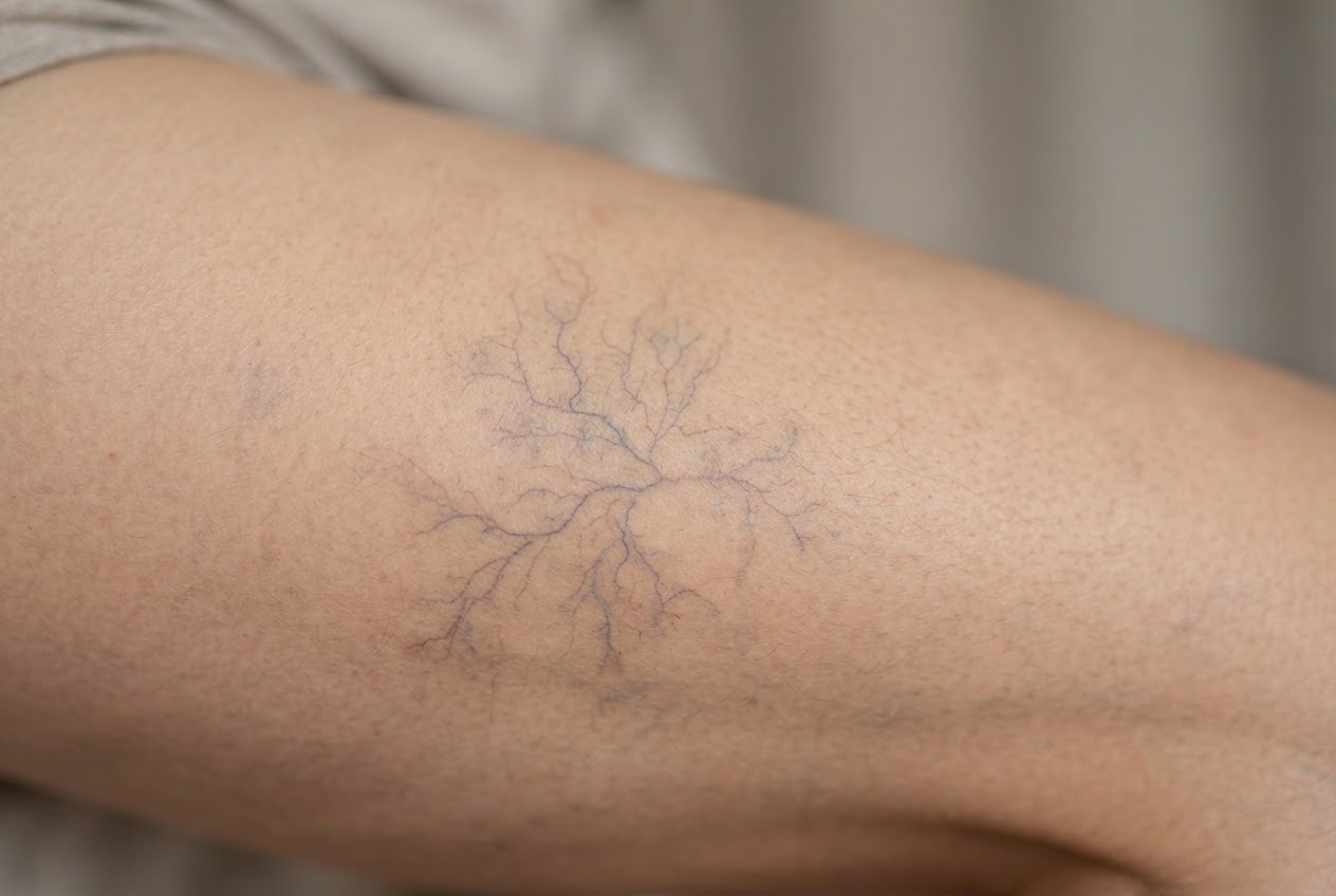 Close-up of a woman's thigh showing fine blue-red spider veins under the skin.