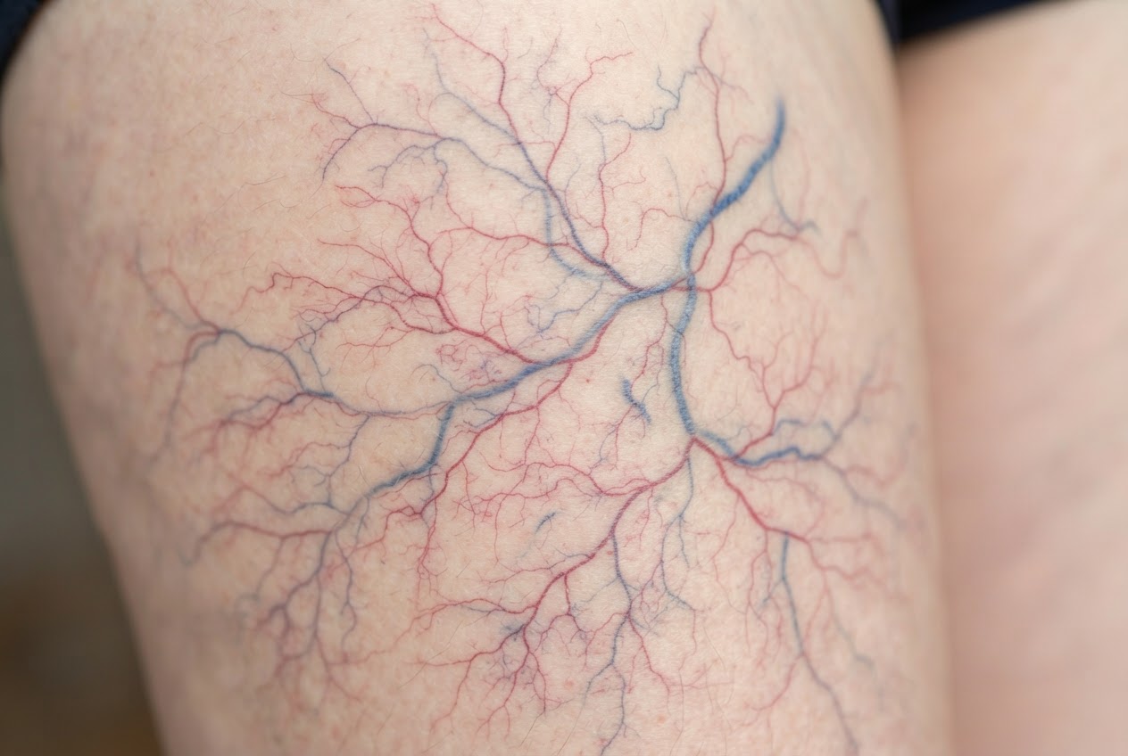 Close-up of a thigh with a network of veins of different thicknesses, some fine and some thicker.