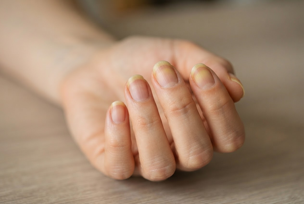 Close-up of a hand with slightly yellowed fingernails.