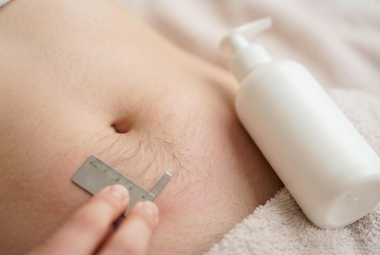 A close-up of a belly with hair about five millimeters long, and a bottle of soothing lotion next to it.