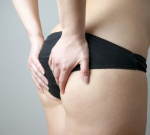 Hausmittel gegen Cellulite