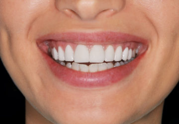 Kosmetische Zahnaufhellung