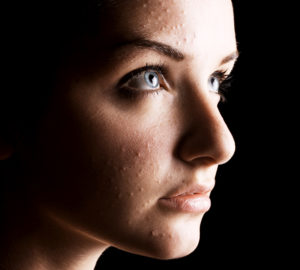 Gesichtspflege gegen Pickel