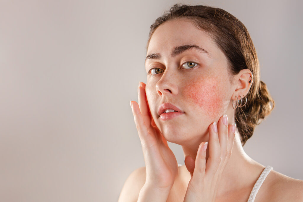 LED-Gesichtsmaske bei Rosacea