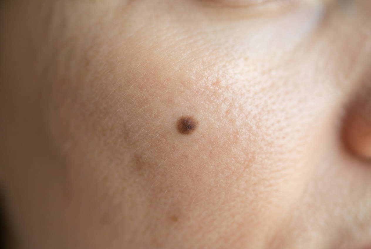 Close-up of skin with a single dark spot left after a healed pimple.