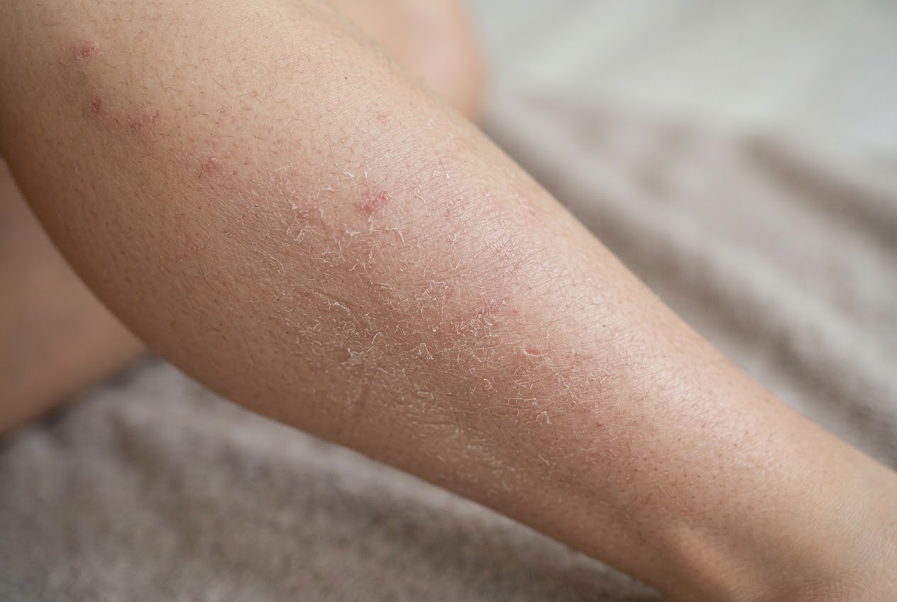 Close-up of a lower leg with dry, flaky skin and slight redness.